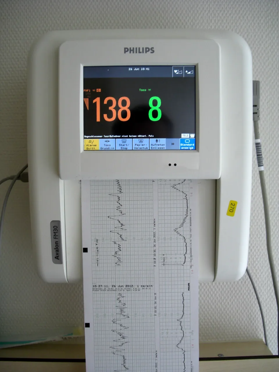 A Philips cardiotocograph with its display and paper recording, photographed in June 2012. Archive equipment example.